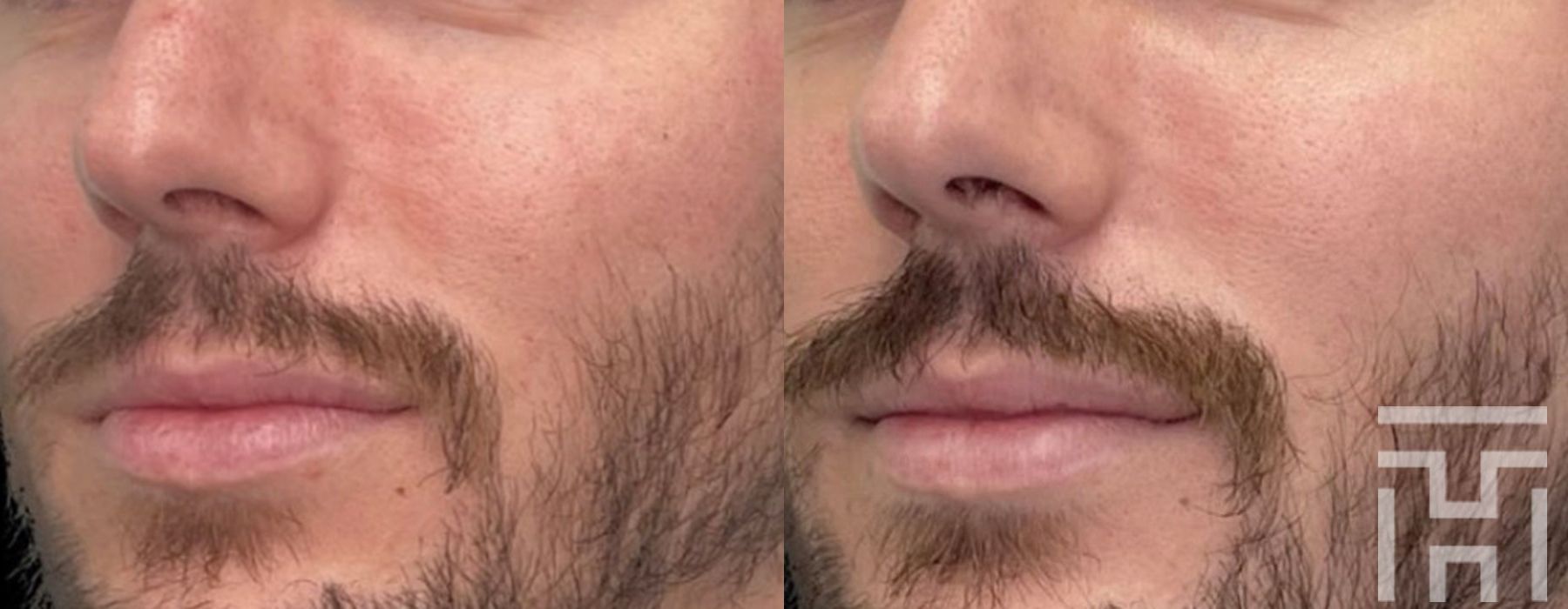 BBL® By Sciton - Case 8627