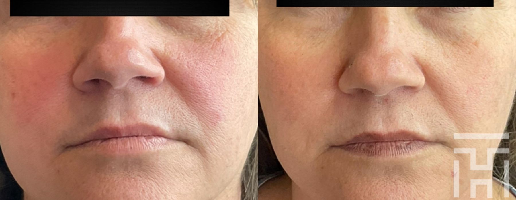 BBL® By Sciton - Case 8633