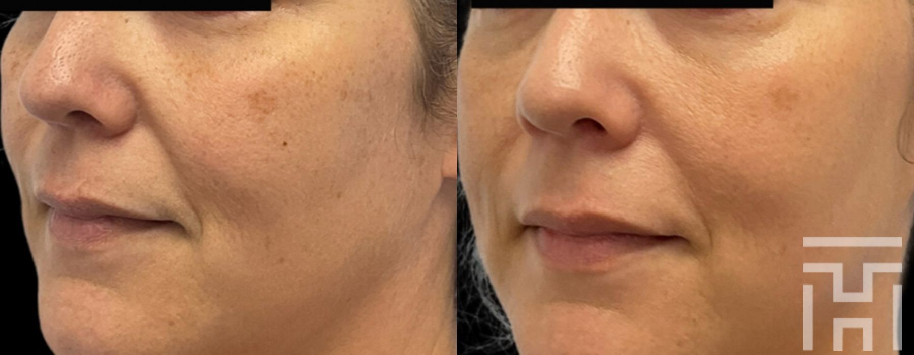 BBL® By Sciton - Case 8626