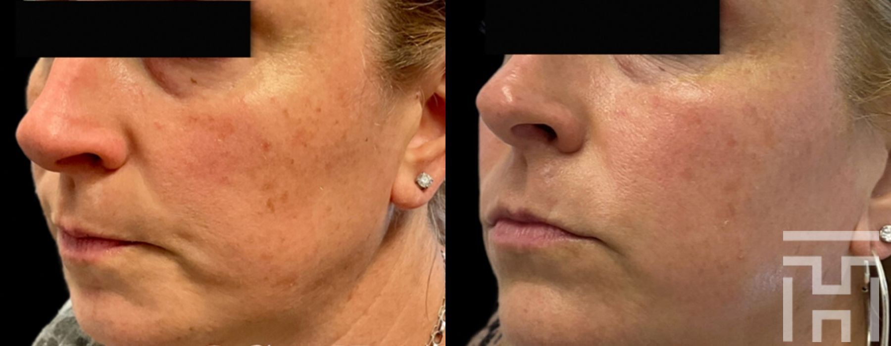 BBL® By Sciton - Thumbnail 2