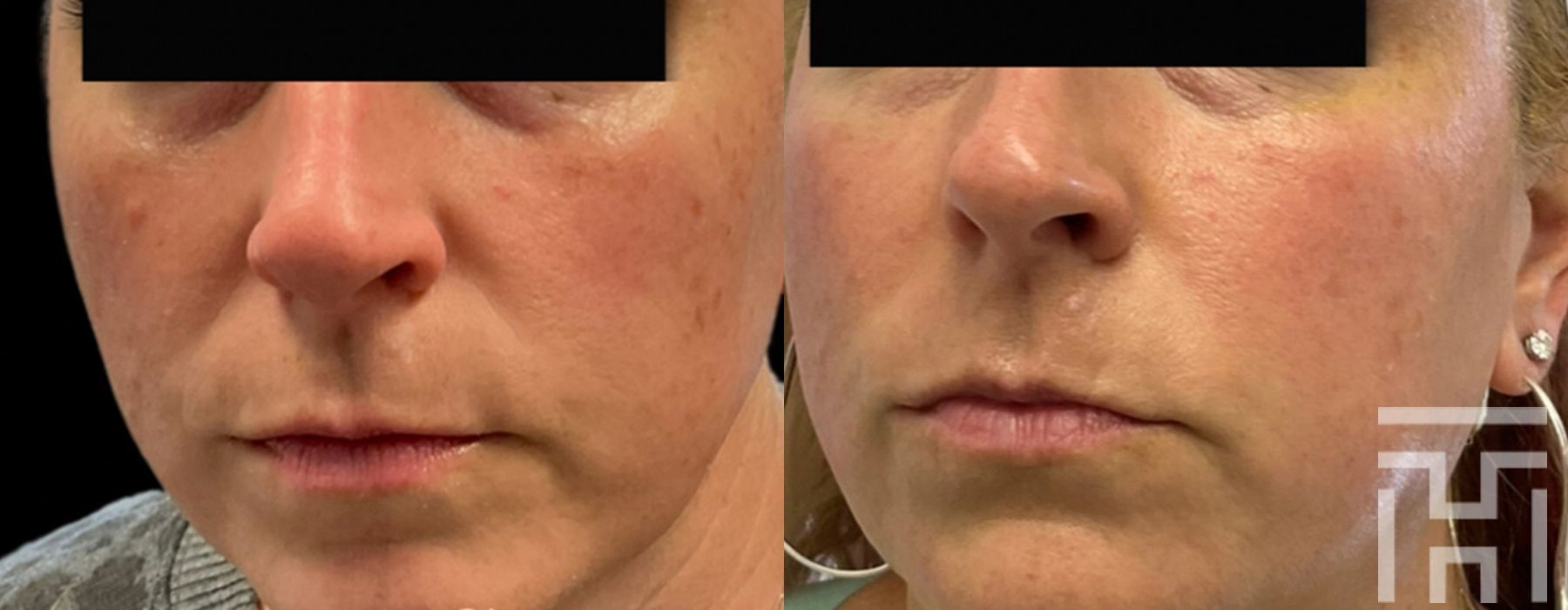 BBL® By Sciton - Case 8636