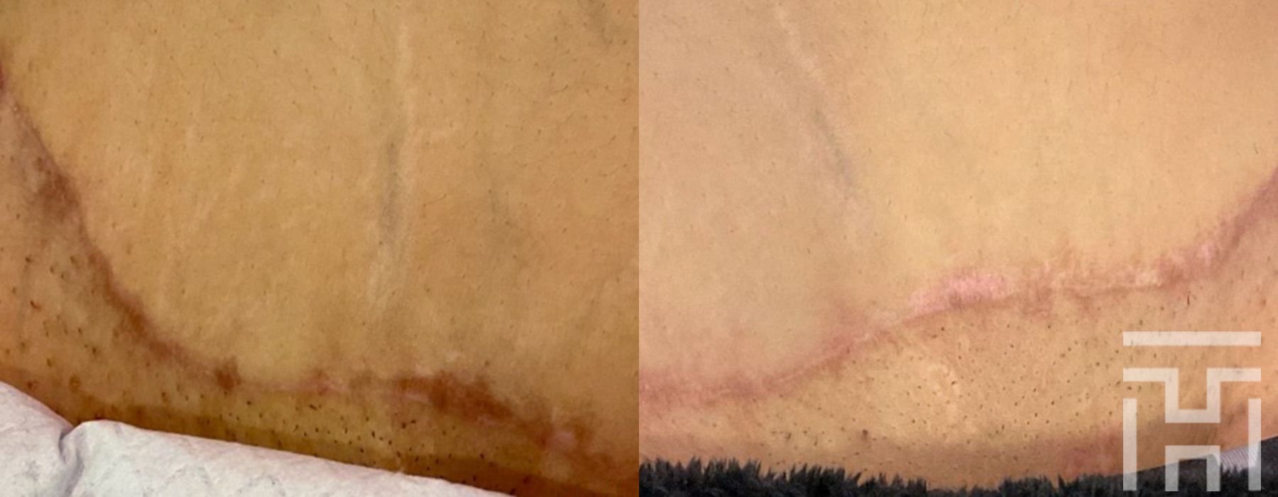 BBL® By Sciton - Case 8628