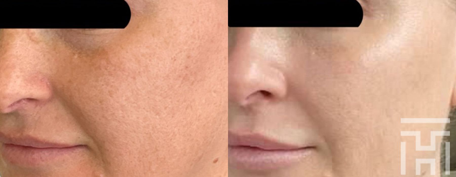 BBL® By Sciton - Case 8634