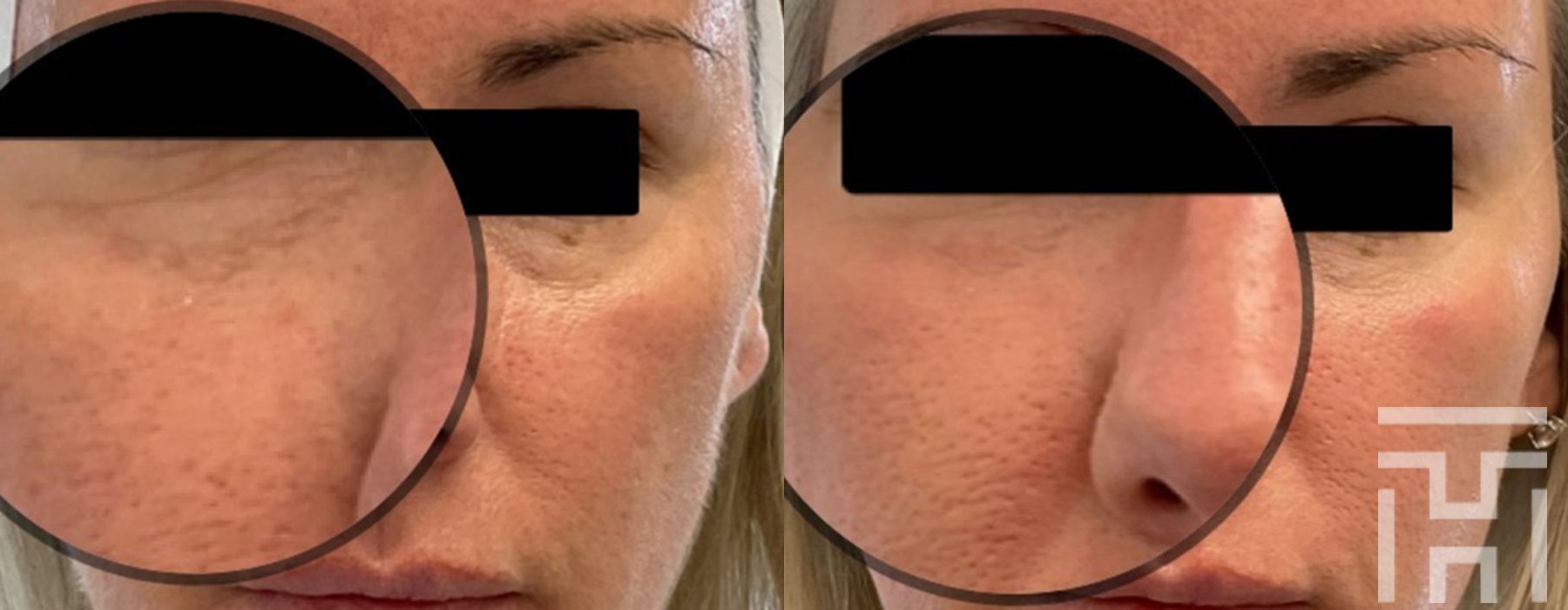 BBL® By Sciton - Thumbnail 2