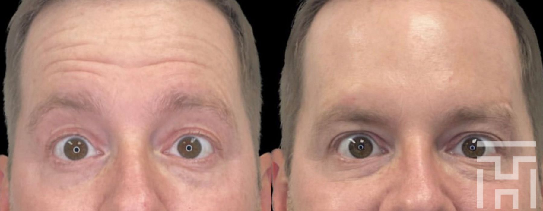 Botox / Dysport / Daxxify - Case 8640