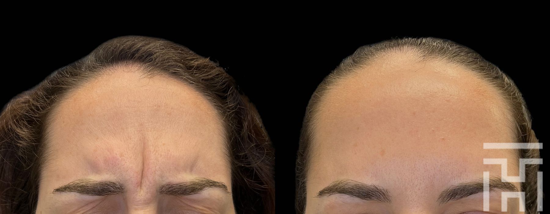 Botox / Dysport / Daxxify - Case 8639