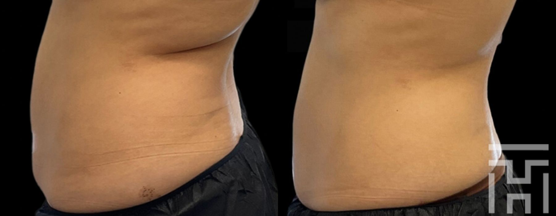 CoolSculpting® - Case 8622