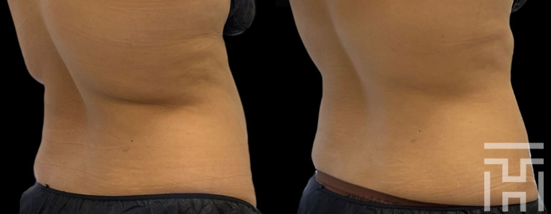 CoolSculpting® - Thumbnail 2