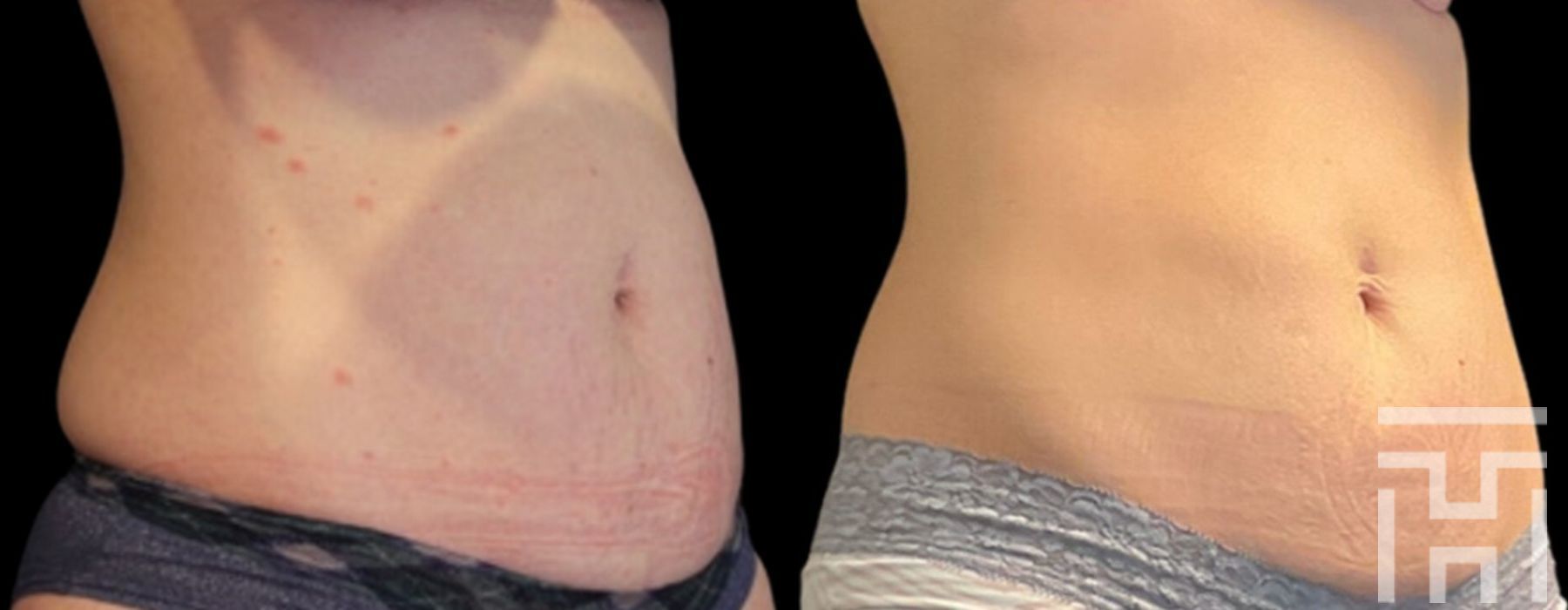 CoolSculpting® - Case 8623