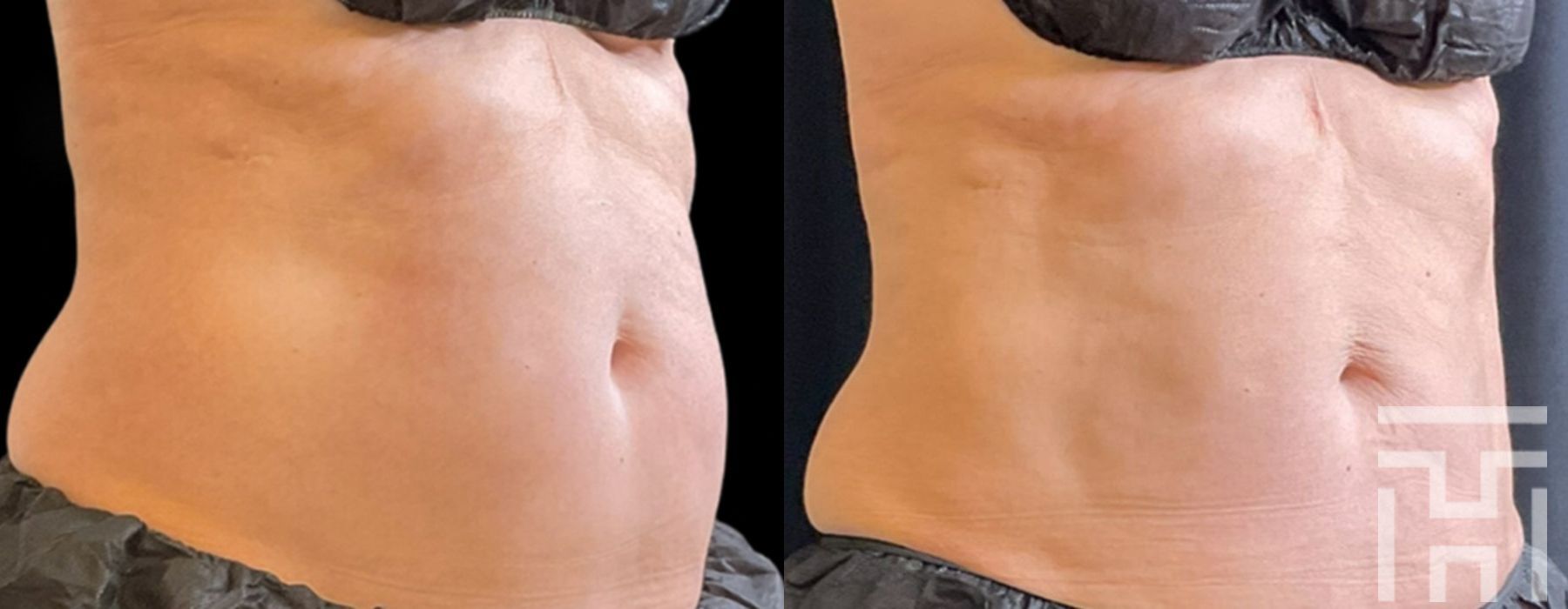 CoolSculpting® - Case 8621