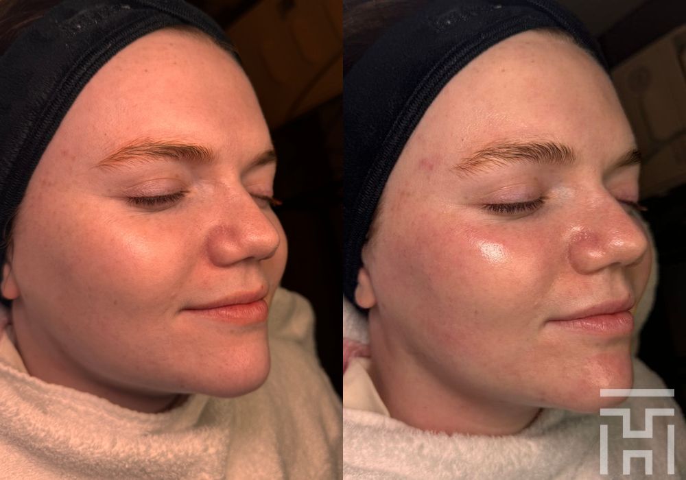 DiamondGlow Facial - Case 8641