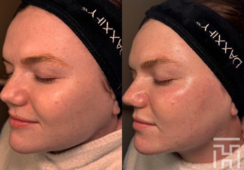 DiamondGlow Facial - Thumbnail 2