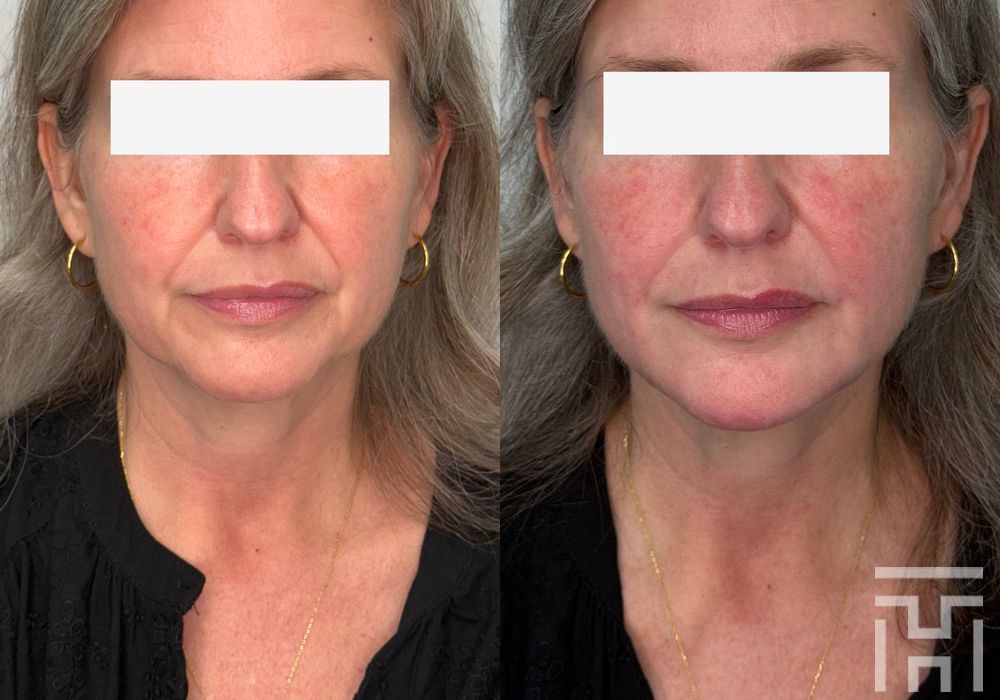 Facial Balancing - Case 8645