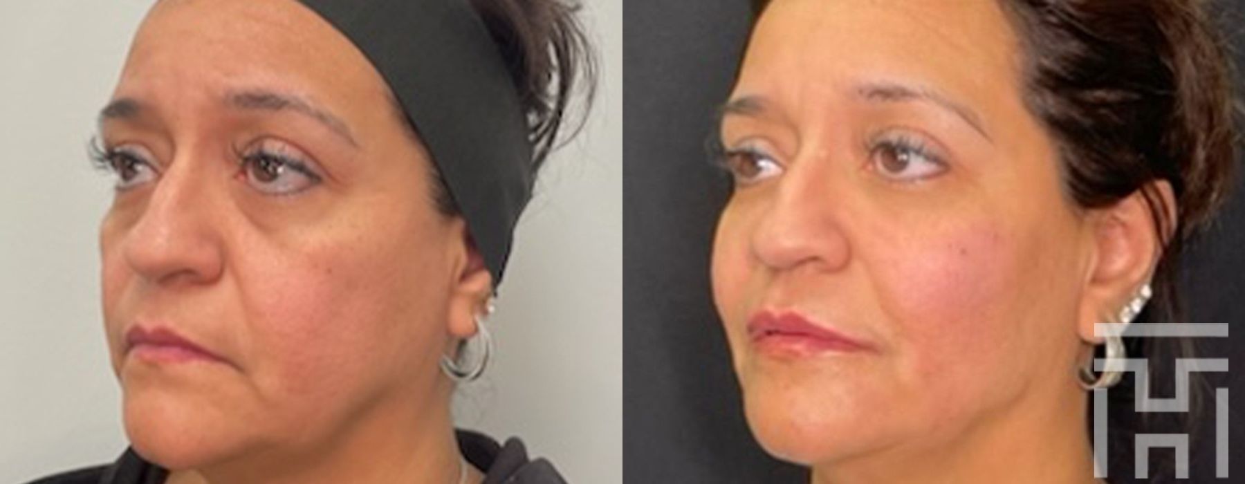 Facial Balancing - Case 8643