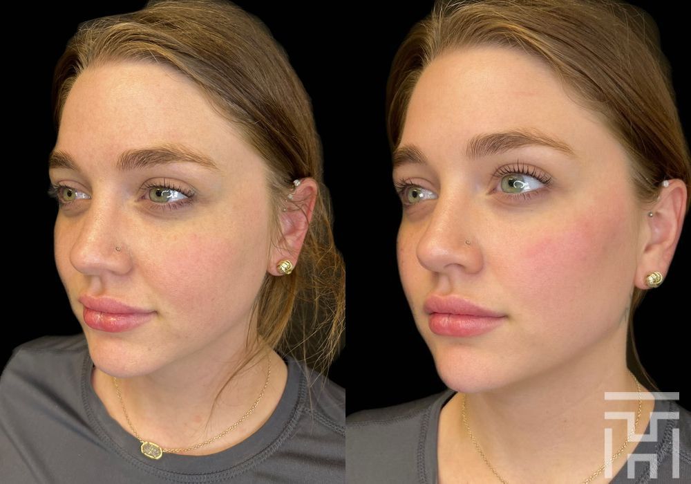 Facial Balancing - Case 8644