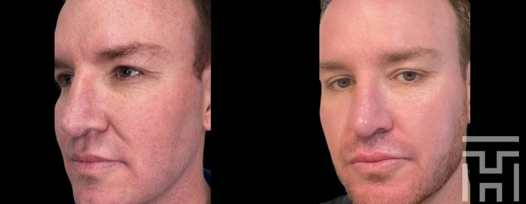 Genius Radiofrequency Microneedling - Case 8673