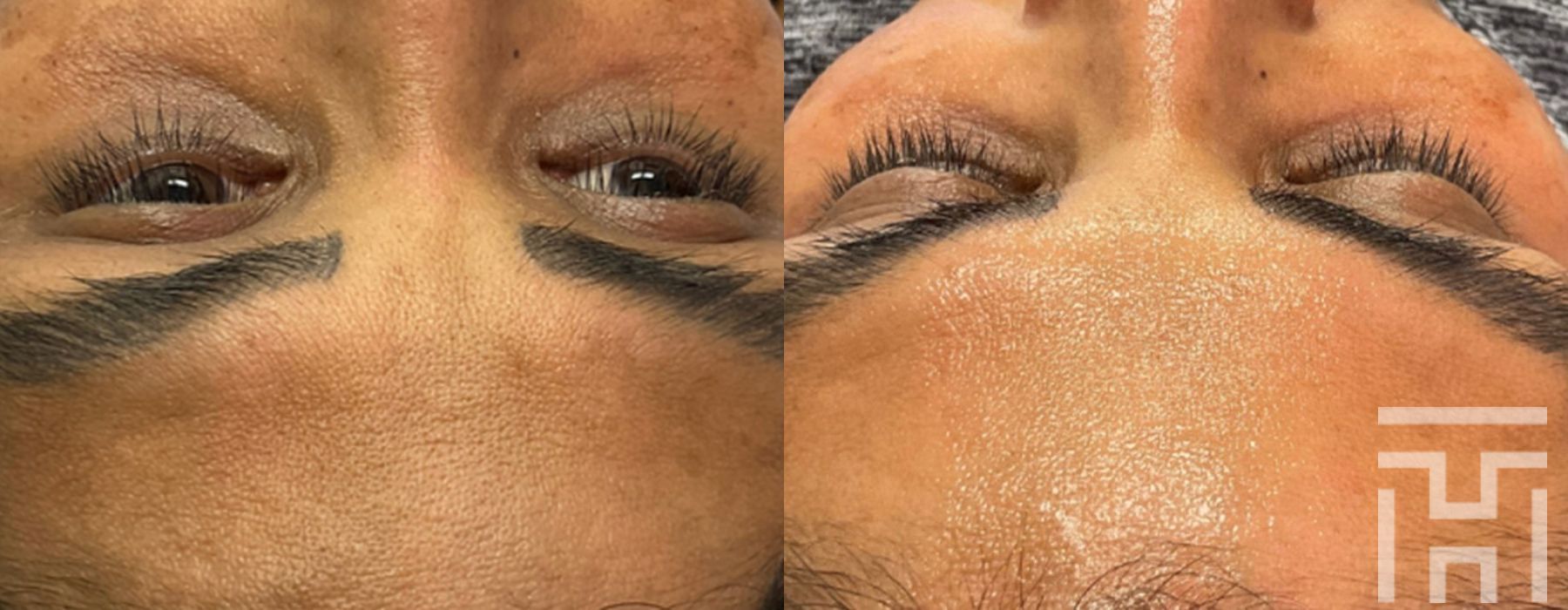 Hydrafacial - Case 8654