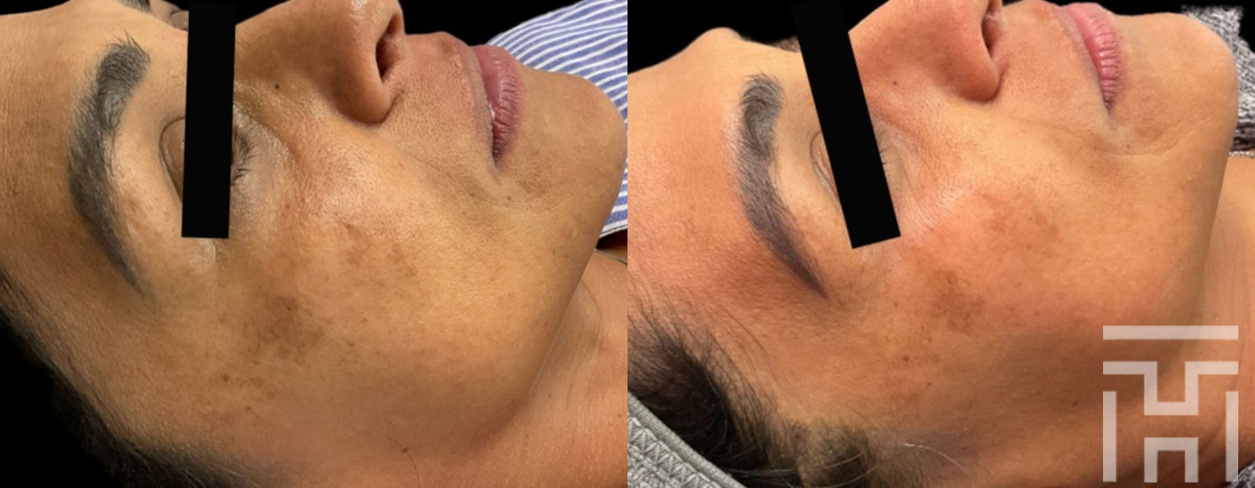 Hydrafacial - Thumbnail 3