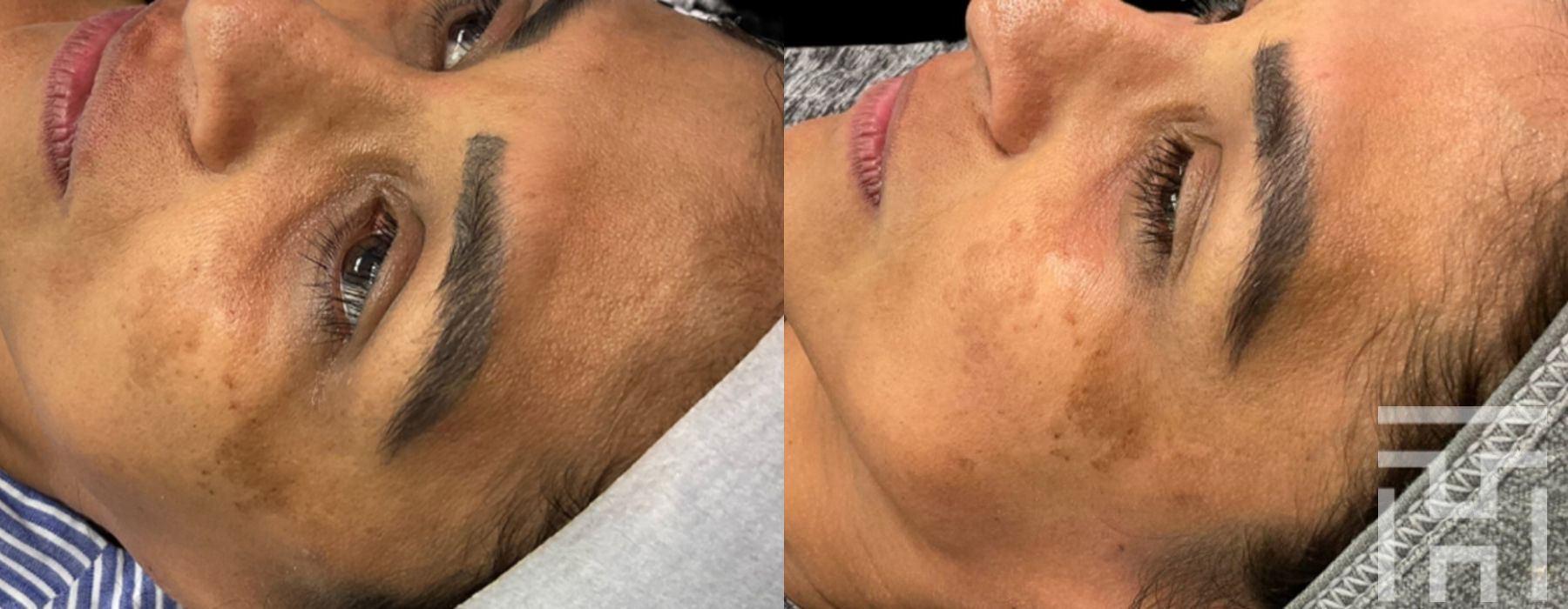 Hydrafacial - Thumbnail 2