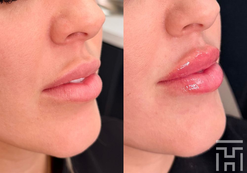 Lip Fillers - Case 8655