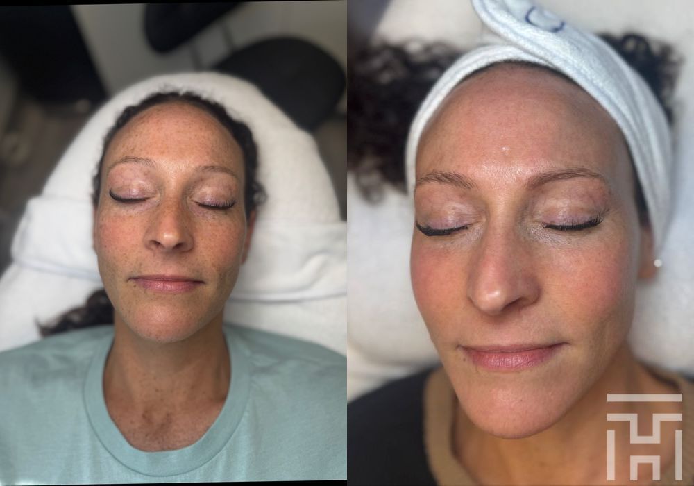 BBL® By Sciton - Thumbnail 2