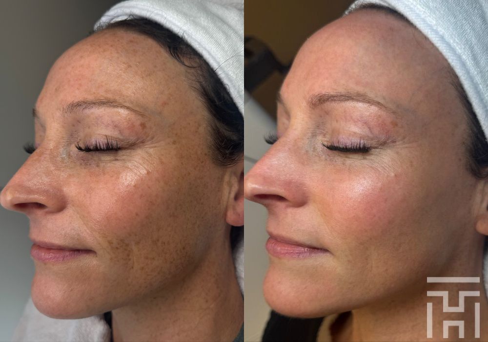 BBL® By Sciton - Case 8624