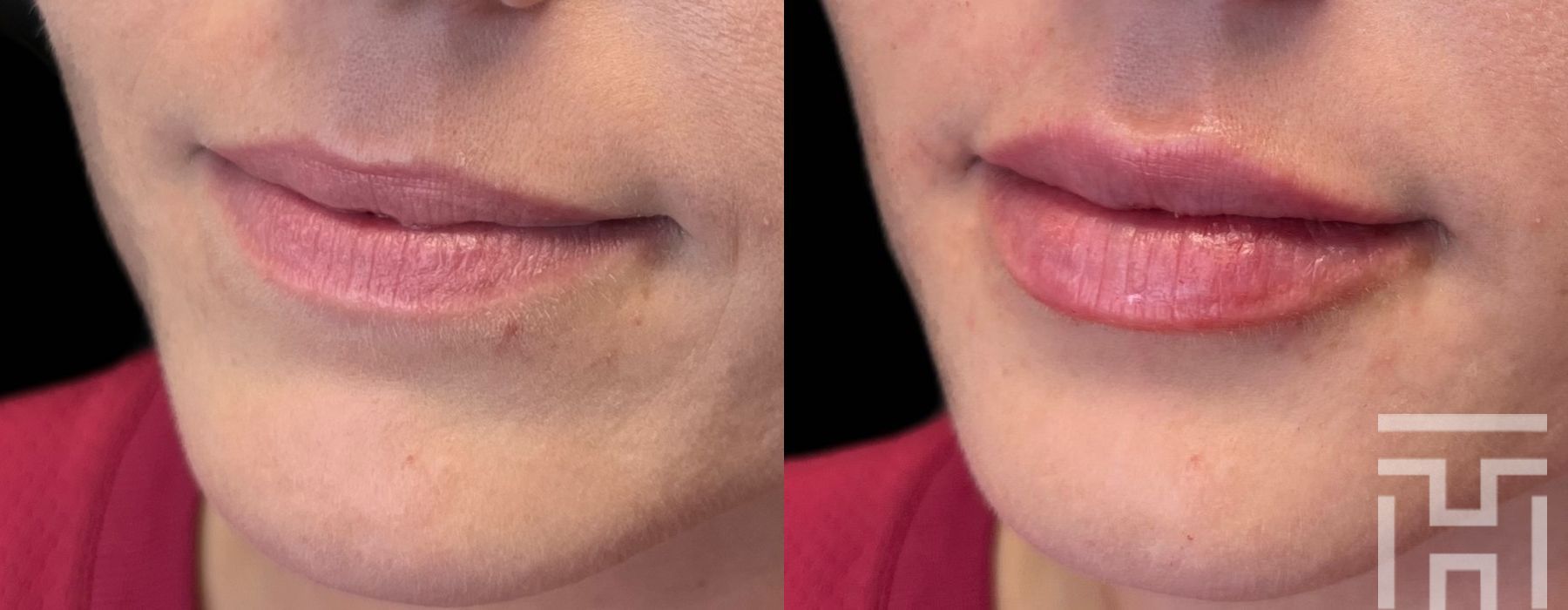 Lip Fillers - Case 8660