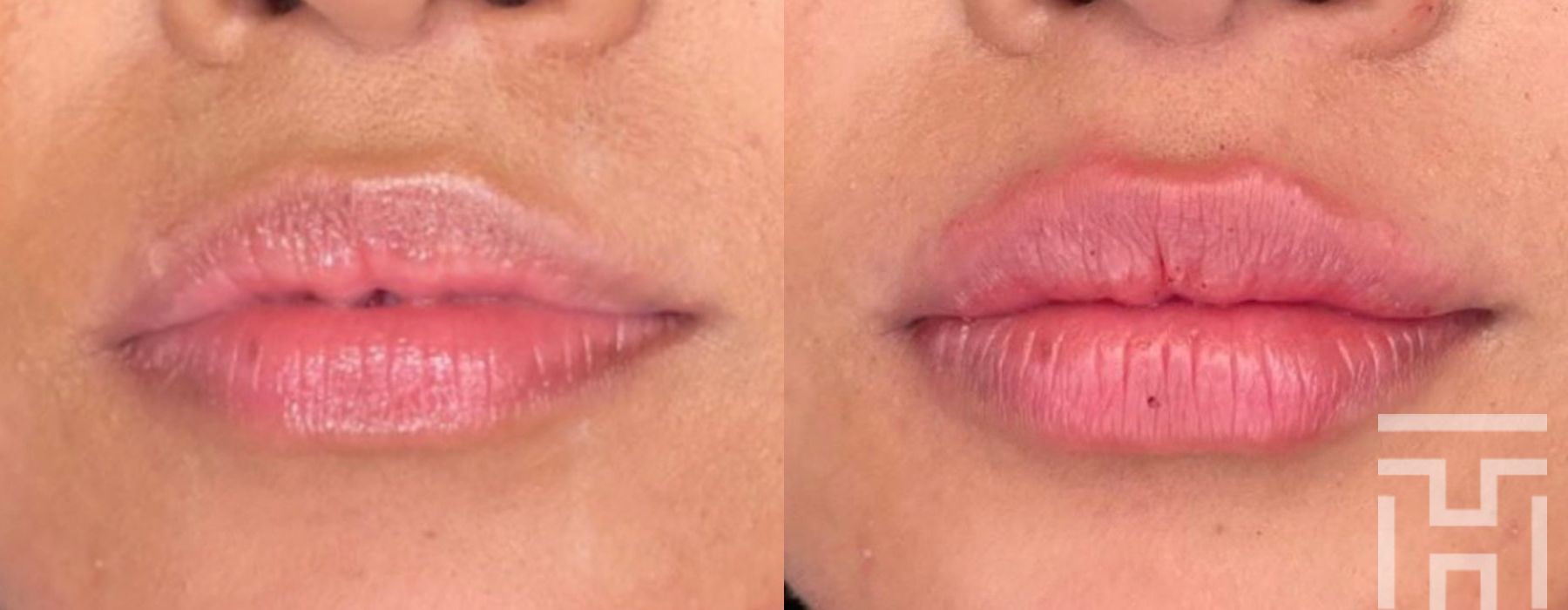 Lip Fillers - Case 8663