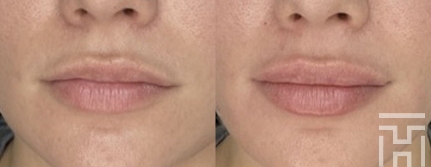 Lip Fillers - Case 8657