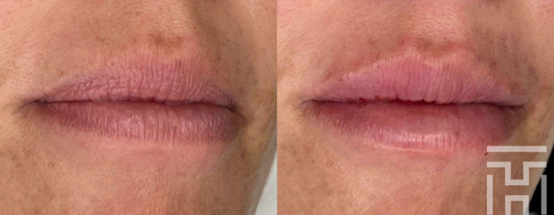Lip Fillers - Case 8665