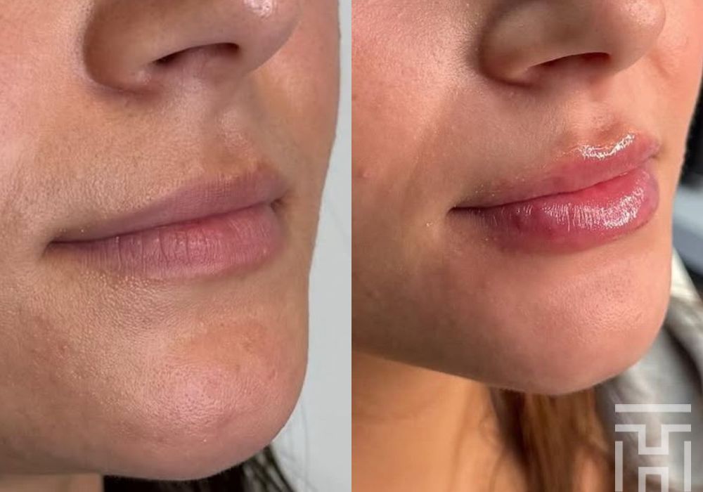 Lip Fillers - Case 8656