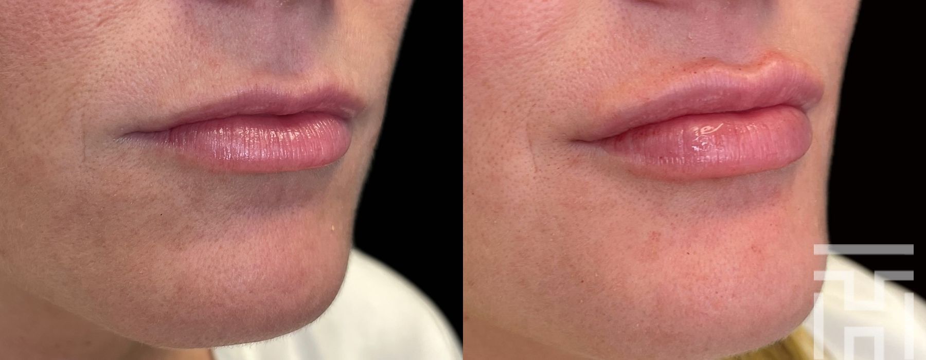 Lip Fillers - Case 8661