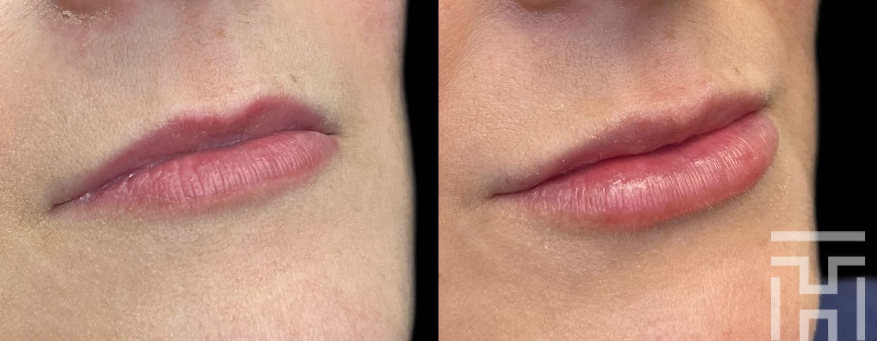 Lip Fillers - Case 8659