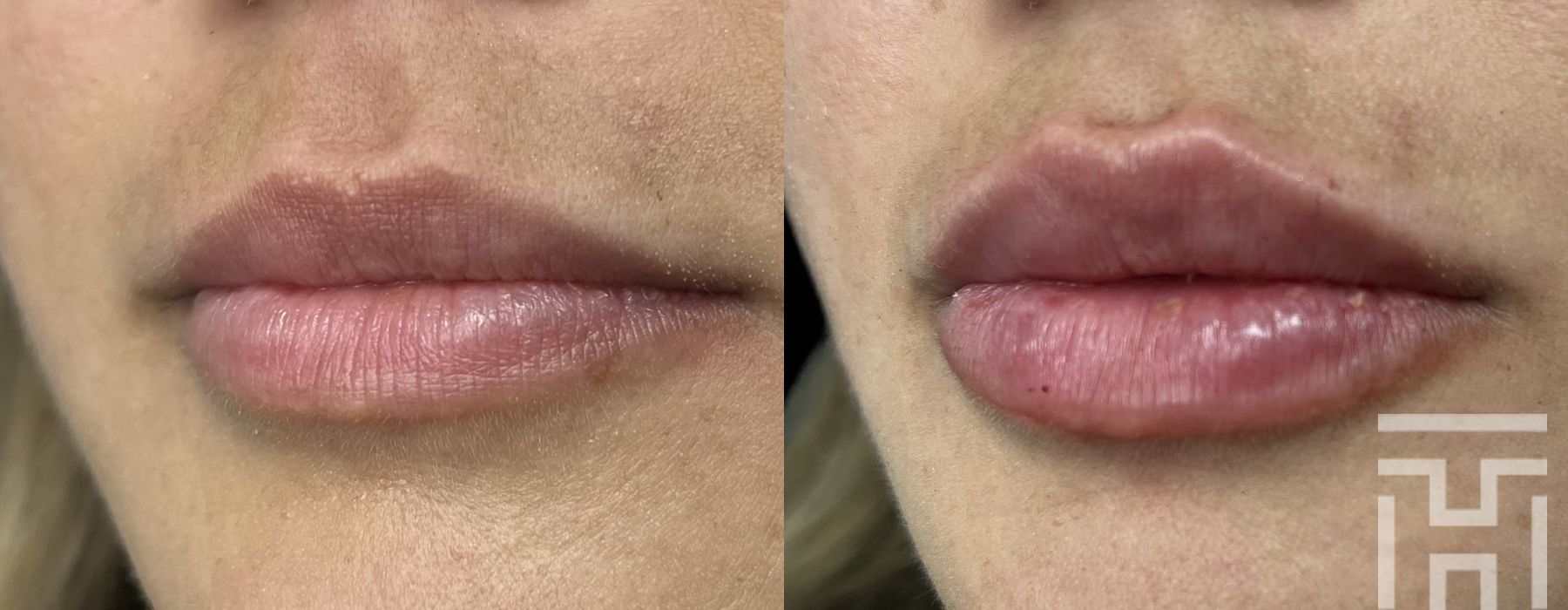 Lip Fillers - Case 8658