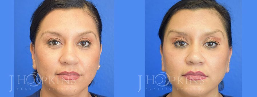 BOTOX Cosmetic - Case 10578