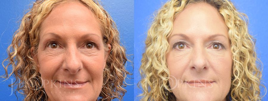 BOTOX Cosmetic - Thumbnail 2