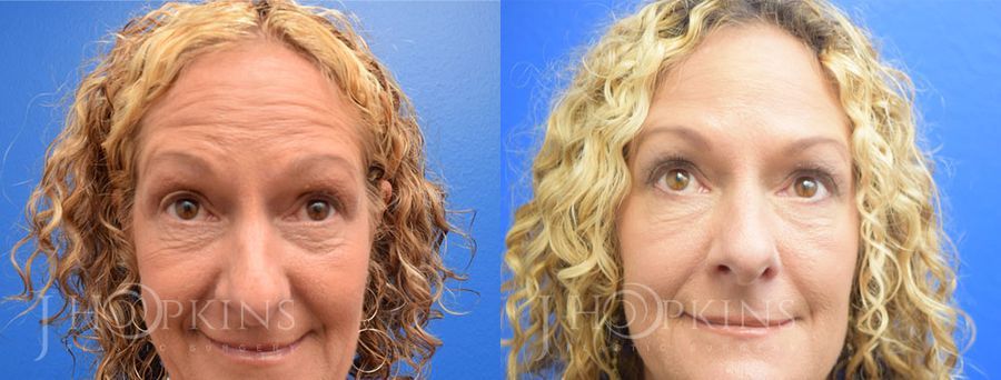 BOTOX Cosmetic - Case 10579