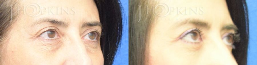 Blepharoplasty - Thumbnail 2