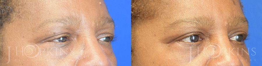 Blepharoplasty - Thumbnail 2