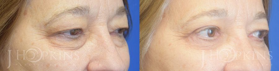 Blepharoplasty - Thumbnail 2