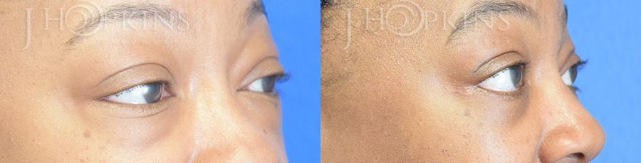 Blepharoplasty - Thumbnail 2