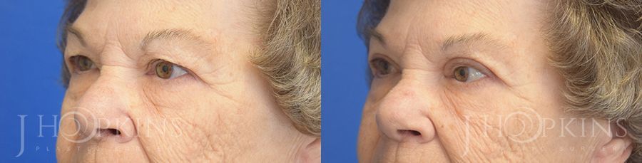 Blepharoplasty - Thumbnail 2