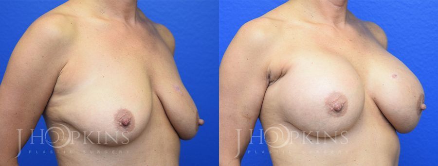 Breast Augmentation - Thumbnail 4