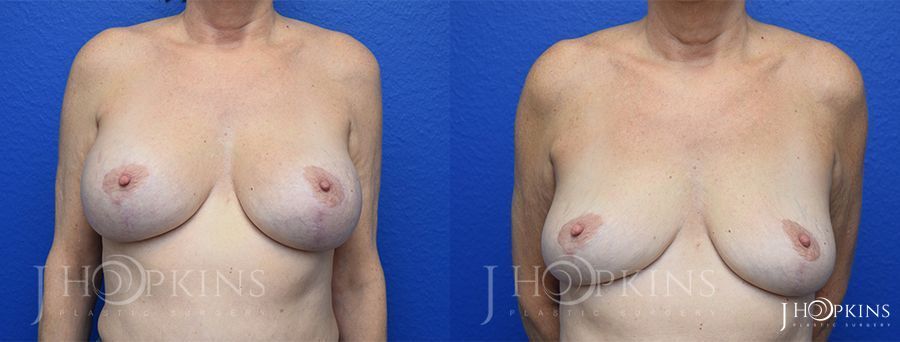 Breast Implant Removal - Case 10524