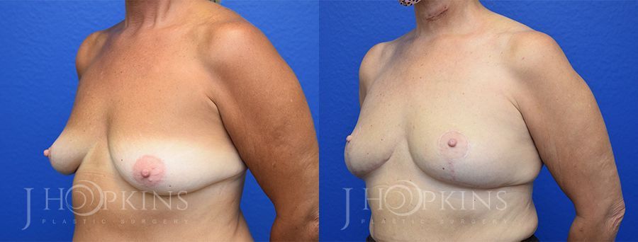 Breast Lift - Thumbnail 2