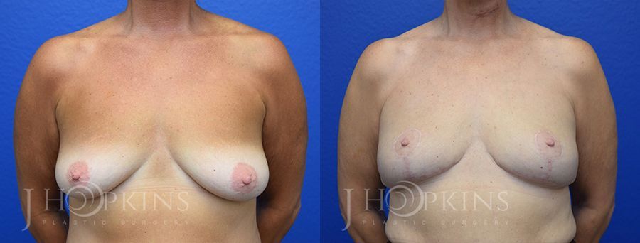 Breast Lift - Case 10525