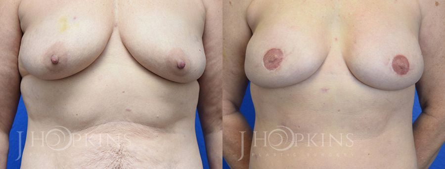 Breast Reconstruction - Case 10528