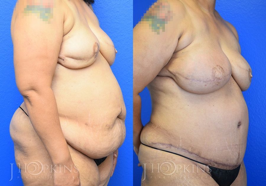 Breast Reconstruction - Thumbnail 2