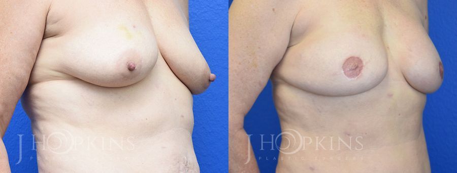 Breast Reconstruction - Thumbnail 2