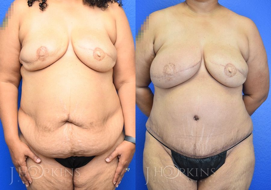 Breast Reconstruction - Case 10529